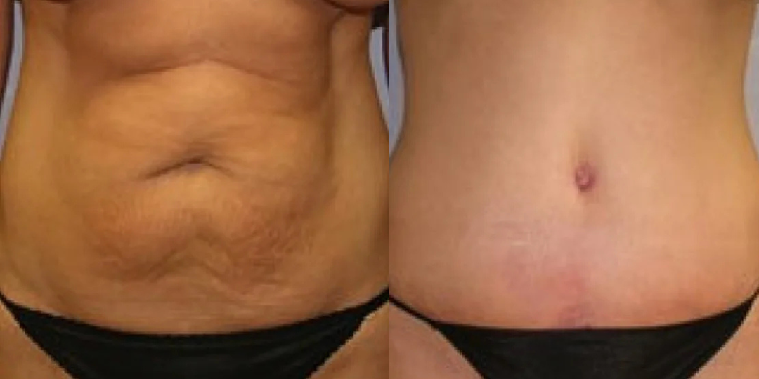 PureLuxe™ Red Light Therapy Belt