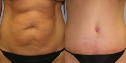 PureLuxe™ Red Light Therapy Belt